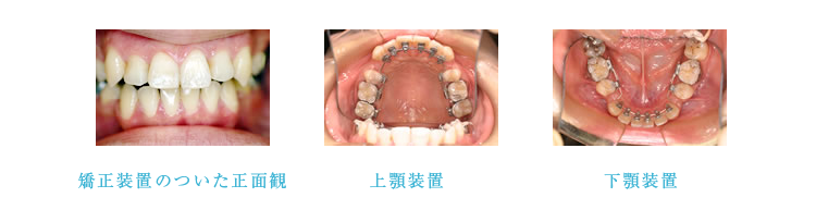 前歯を後ろに下げます