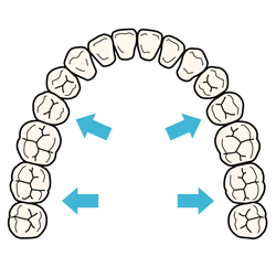 歯列を側方へ拡大する