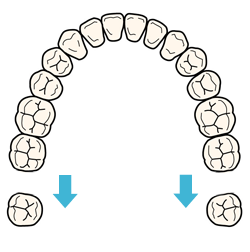 奥歯を後方へ移動する